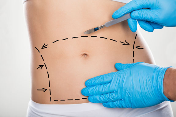 Abdominoplastik Erding